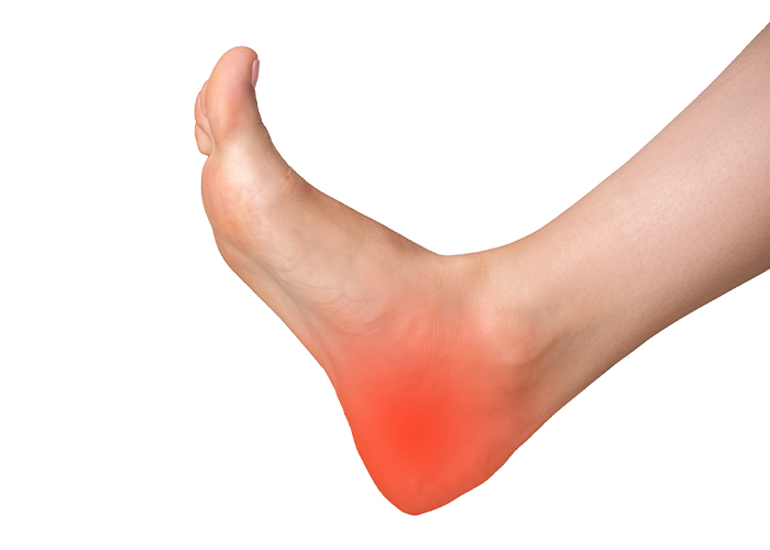 خار پاشنه: علل، علائم و راههای درمان معرفی خار پاشنه