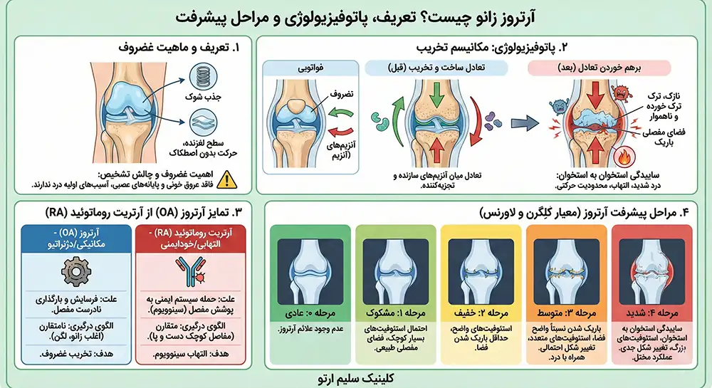 آرتروز زانو آرتروز زانو چیست؟ تعریف، پاتوفیزیولوژی و مراحل پیشرفت