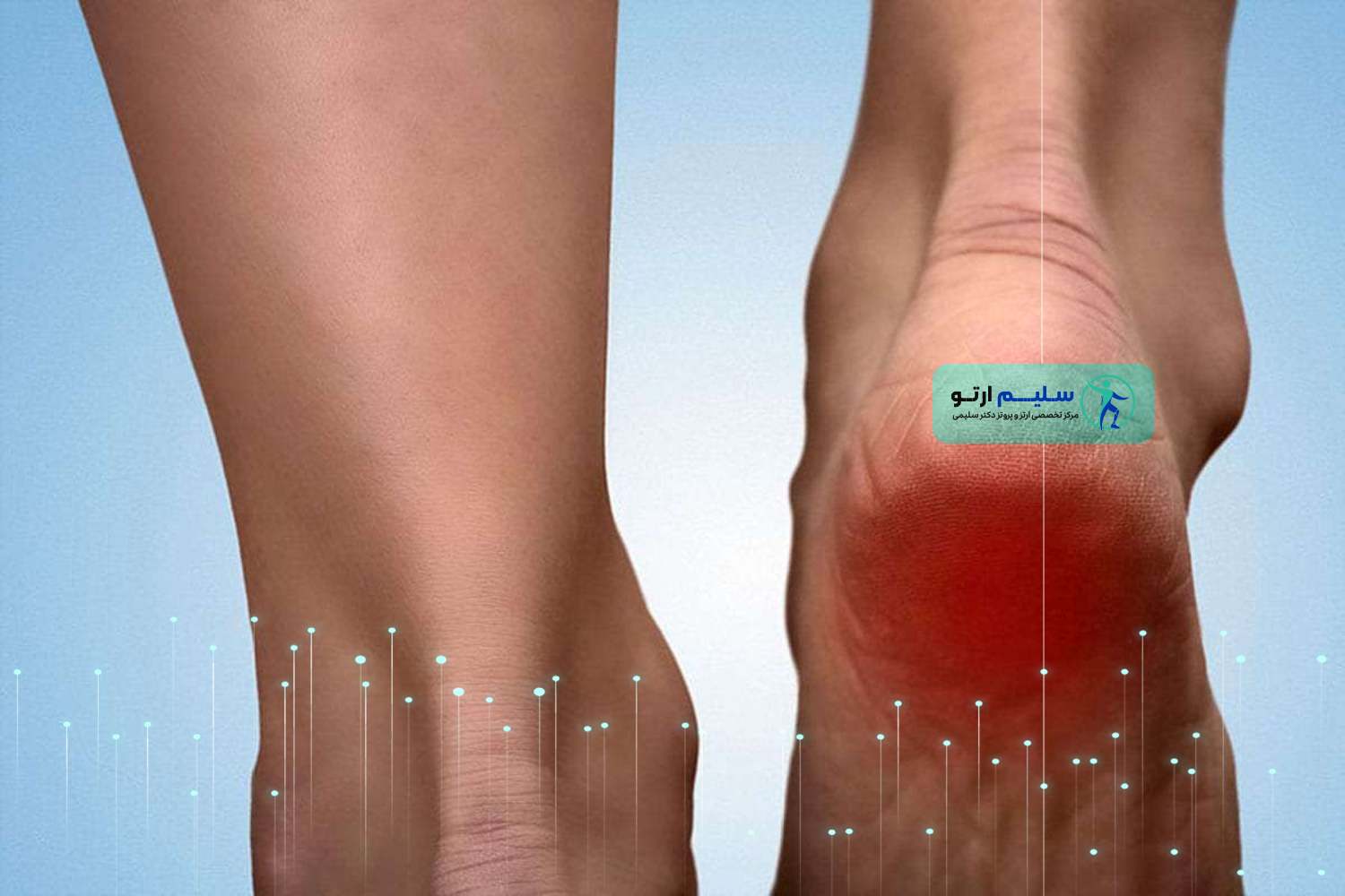 خار پاشنه چیست و راه های درمان خارپاشنه درمان خار پاشنه