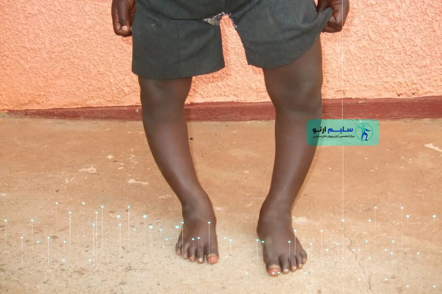 پای پرانتزی در بزرگسالان درمان زانوی پرانتزی