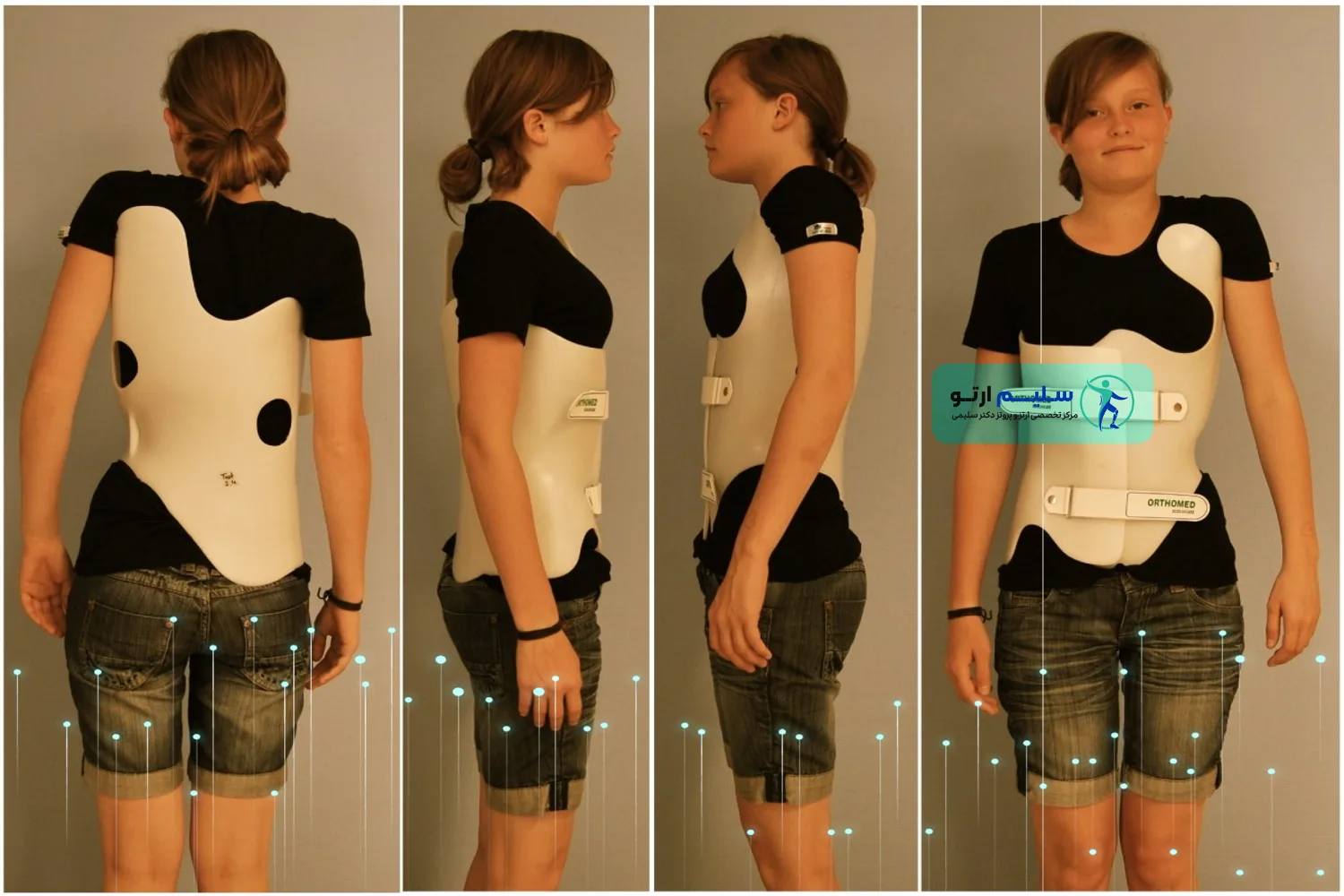 cheneau-brace-picture1 رزرو آنلاین وقت ساخت بریس یا کمربند شنو در سلیم ارتو