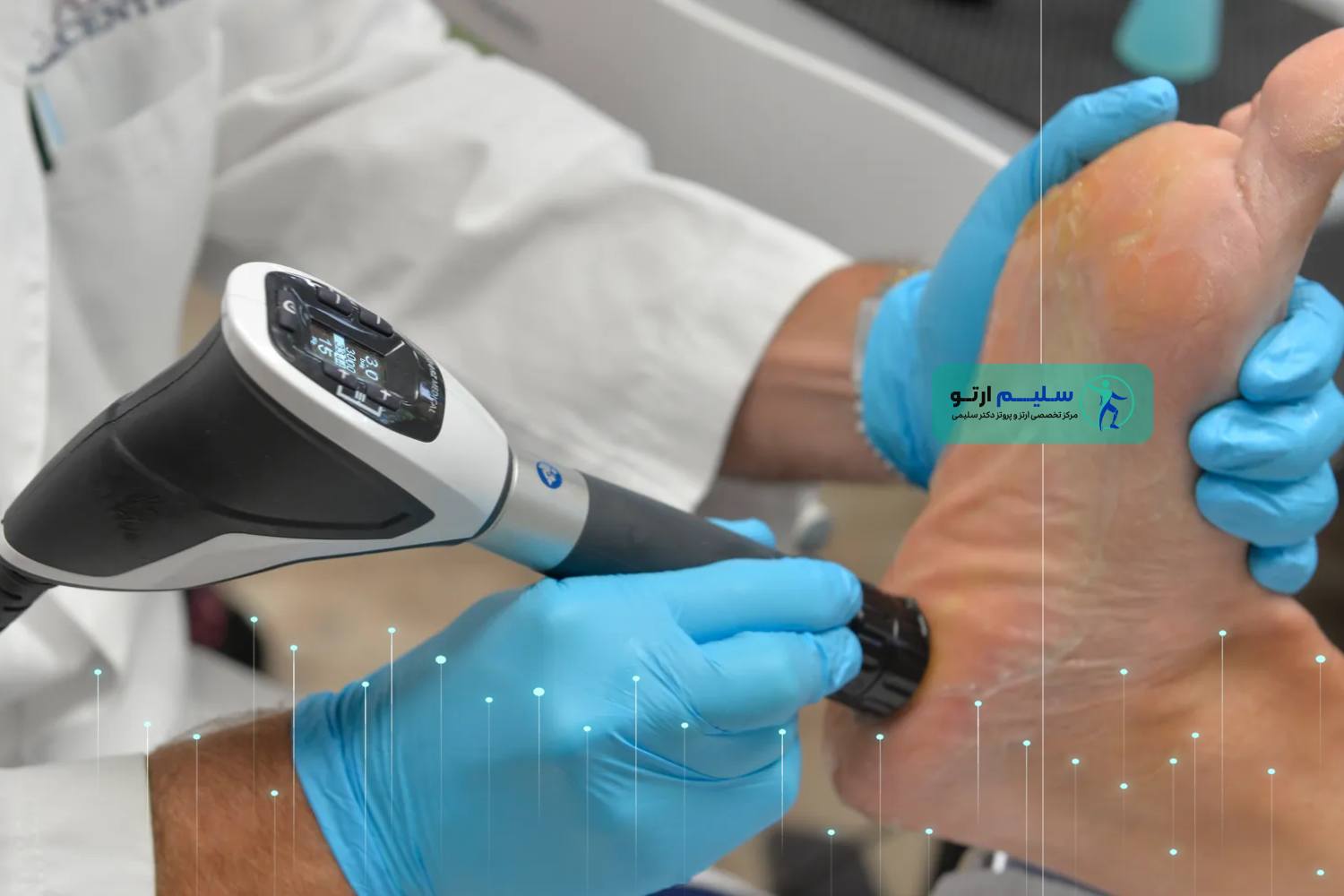 درمان خار پاشنه با لیزر مزایای استفاده از لیزر برای خار پاشنه
