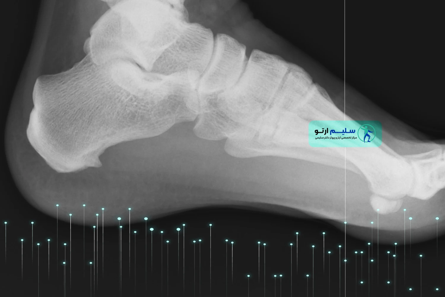 خار پاشنه چیست و راه های درمان خارپاشنه عکس خار پاشنه پا