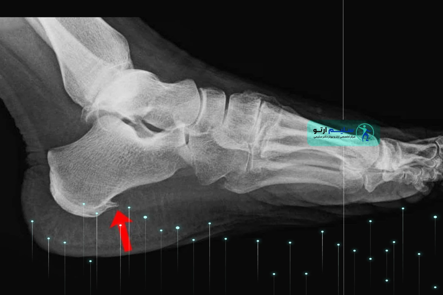 خار پاشنه چیست و راه های درمان خارپاشنه خار پشنه چیست؟