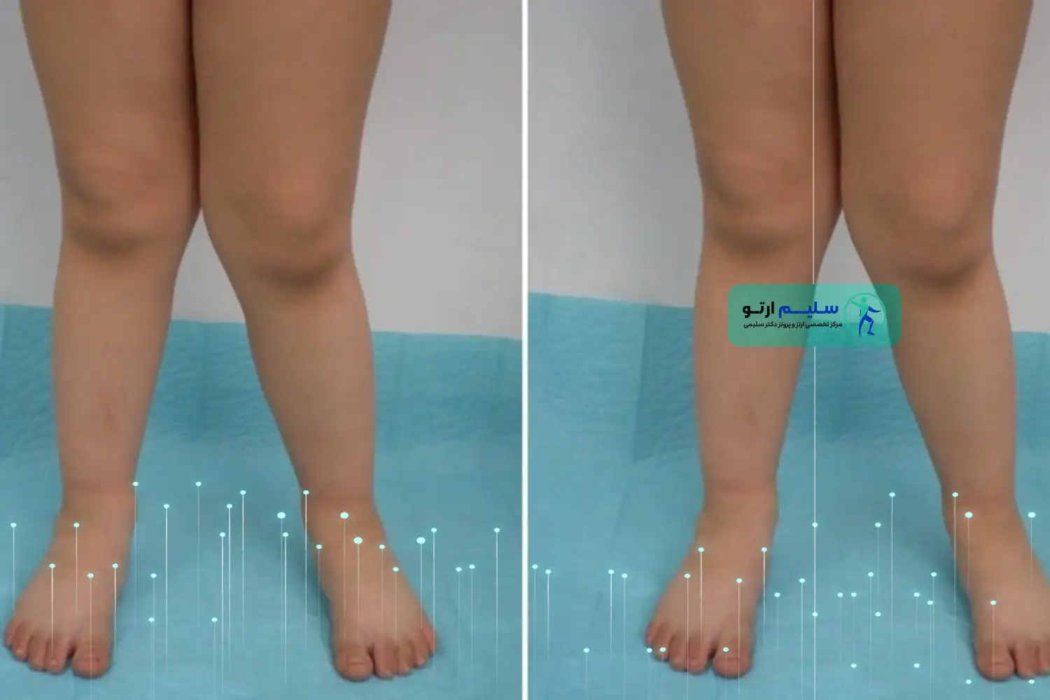 زانوی ضربدری انحراف در زانوی ضربدری