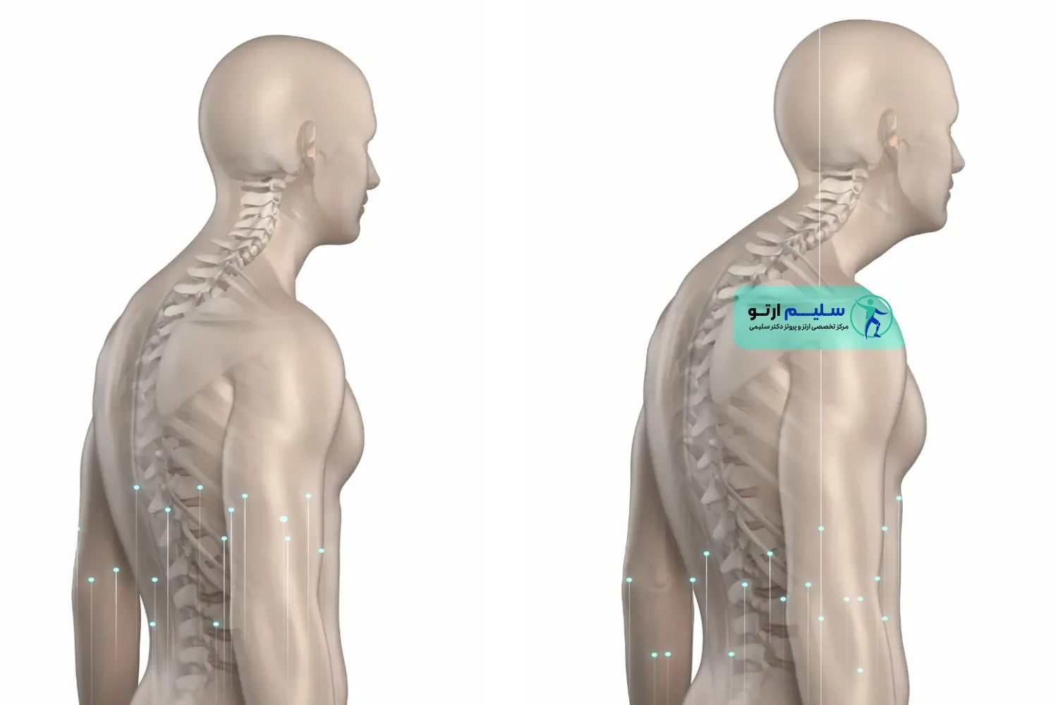 کایفوز کایفوز یا قوز پشتی کمر
