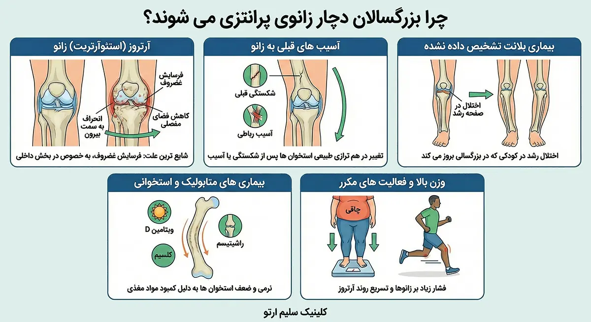پای پرانتزی در بزرگسالان چرا بزرگسالان دچار زانوی پرانتزی می شوند؟