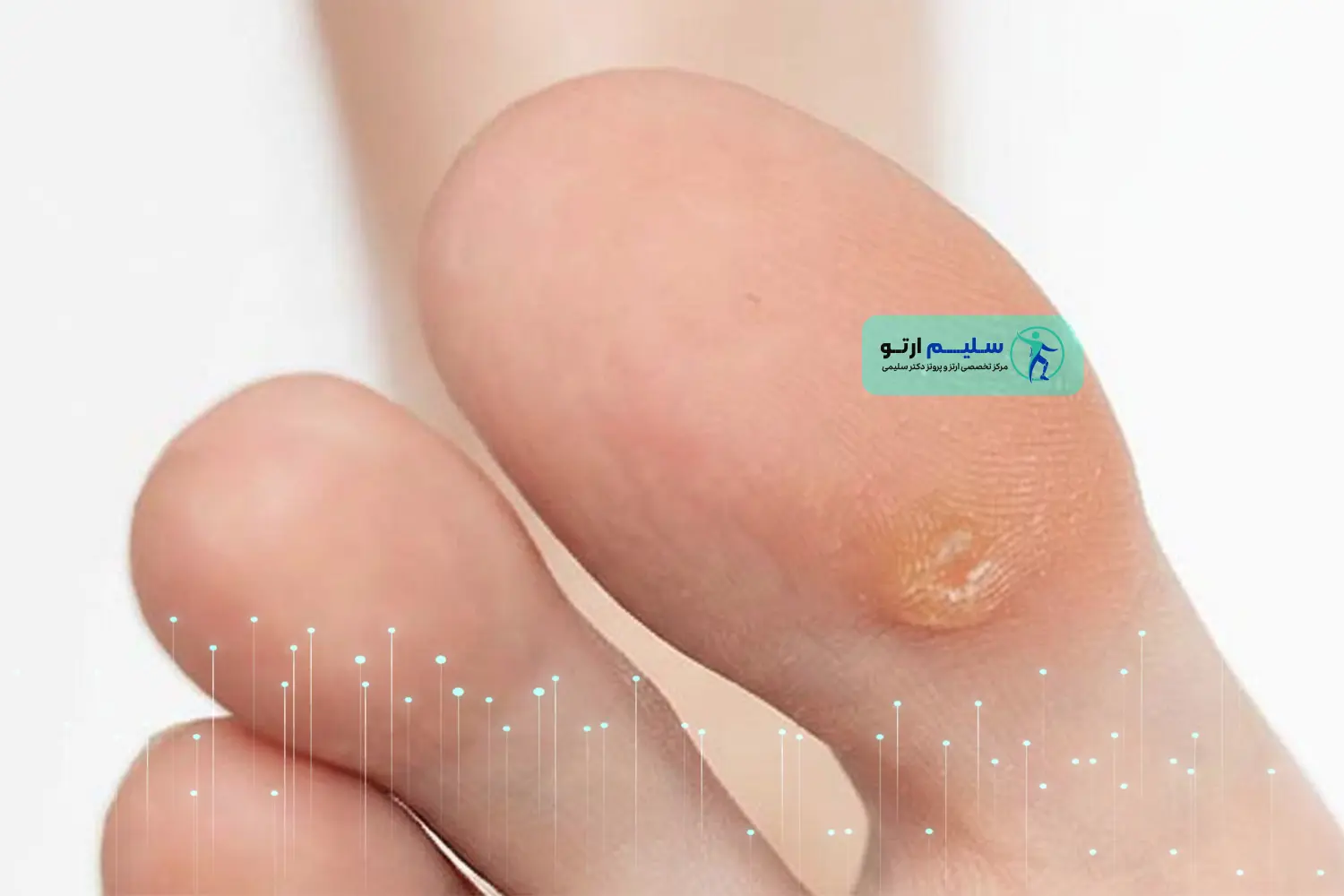 میخچه و پینه؛ علت، پیشگیری و درمان عکس میخچه پا