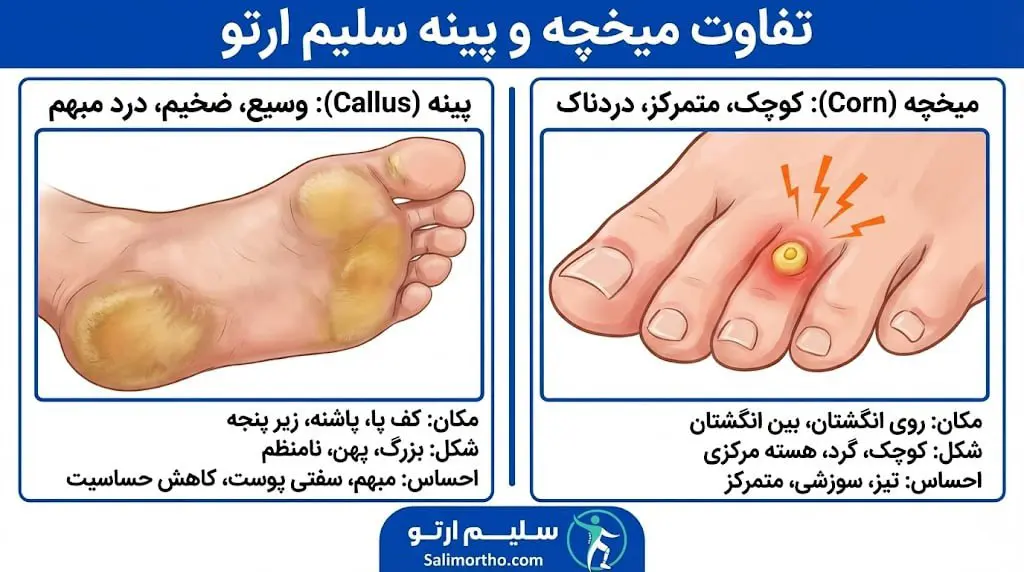 میخچه و پینه؛ علت، پیشگیری و درمان تفاوت میخچه و پینه
