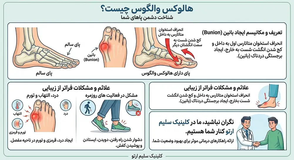 هالوکس والگوس (انگشت شست پای کج) هالوکس والگوس چیست؟
