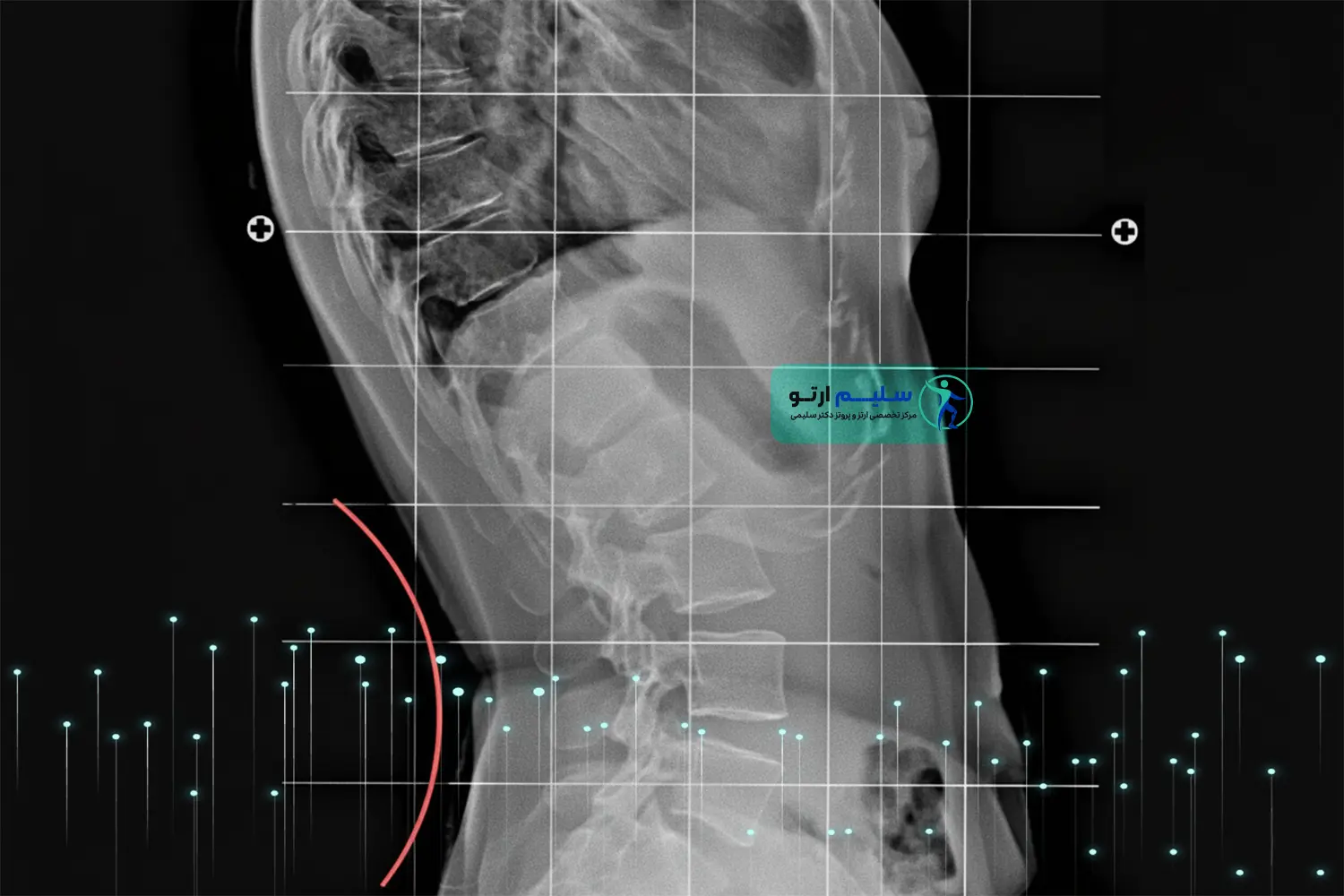گودی کمر (لوردوز) رفع گودی کمر