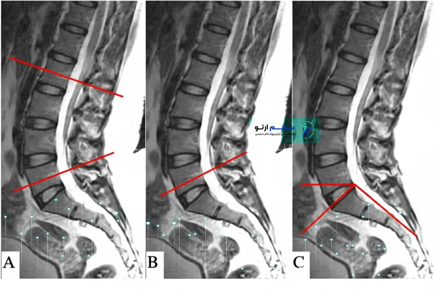 گودی کمر (لوردوز) علائم و عوارض جدی هیپرلوردوزیس: لزوم مراجعه فوری