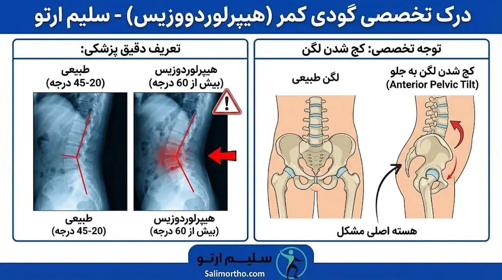 گودی کمر (لوردوز) درمان گودی کمر