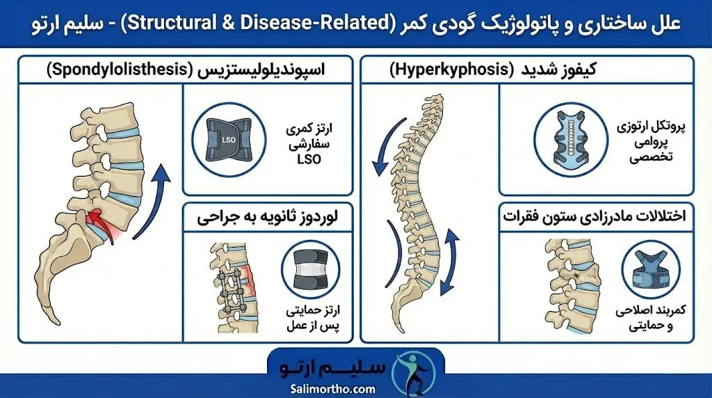 گودی کمر (لوردوز) علل ساختاری گودی کمر (علل ساختاری لوردوز)