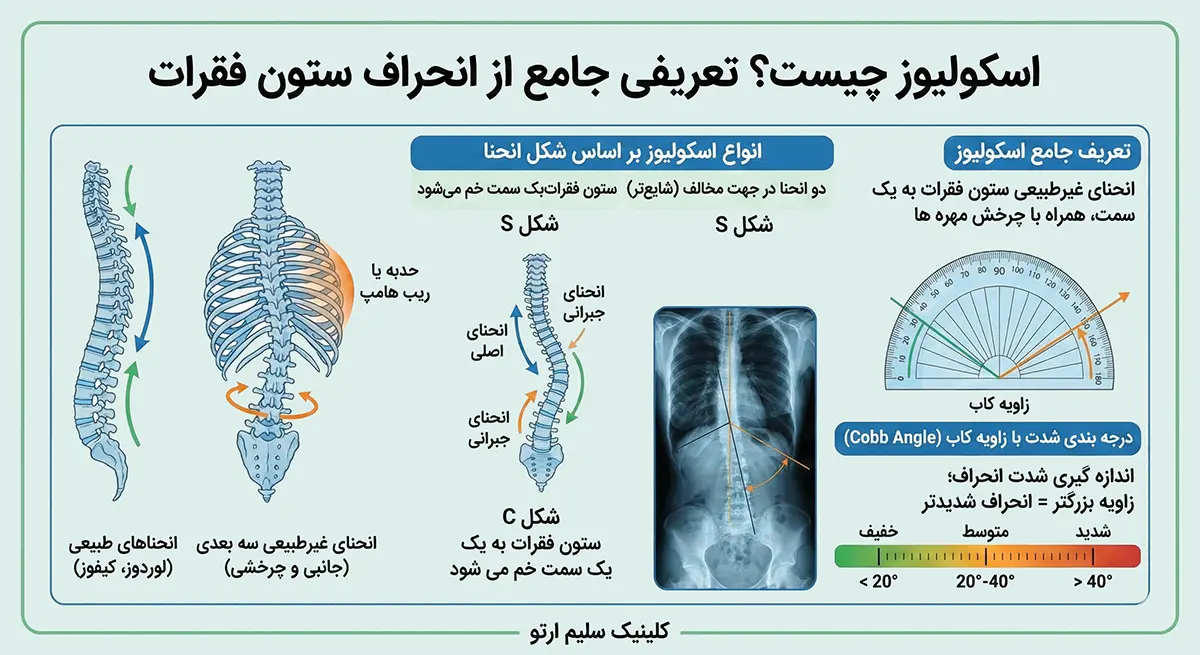 اسکولیوز یا انحراف ستون فقرات چیست و راهکارهای درمانی این بیماری اسکولیوز چیست؟ تعریفی جامع از انحراف ستون فقرات