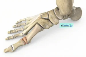 هالوکس ریجیدوس چیست؟