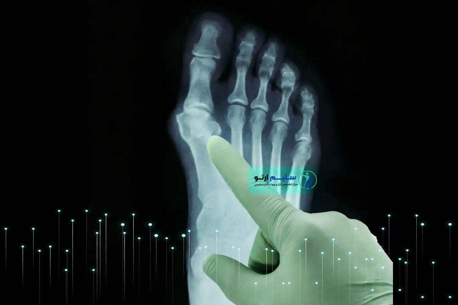 هالوکس ریجیدوس هالوکس ریجیدوس و نقش ارتوپدی فنی