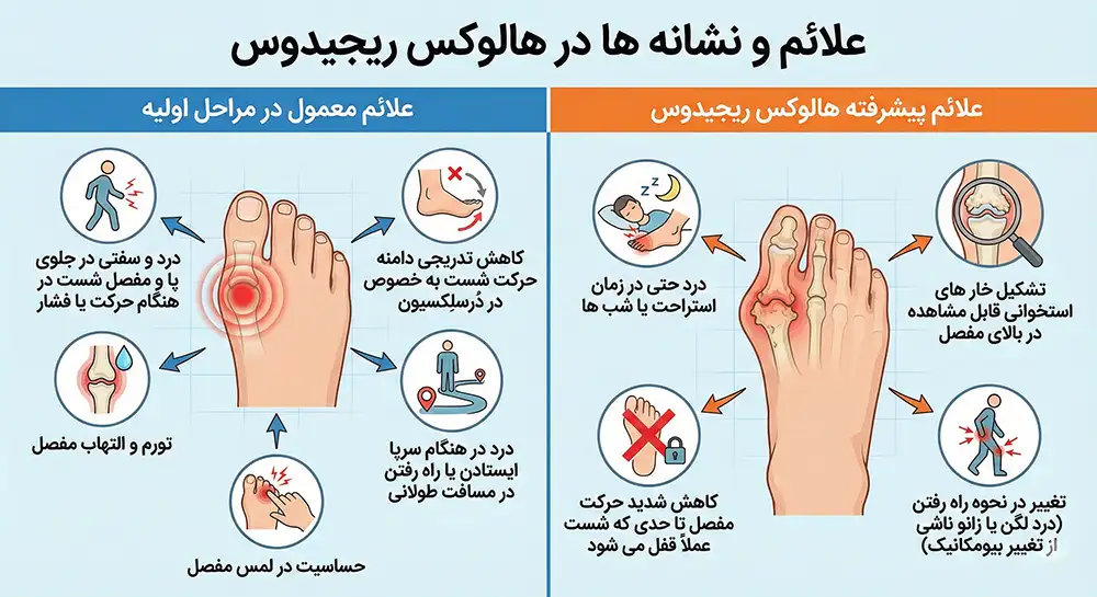 هالوکس ریجیدوس علائم و نشانه ها در هالوکس ریجیدوس