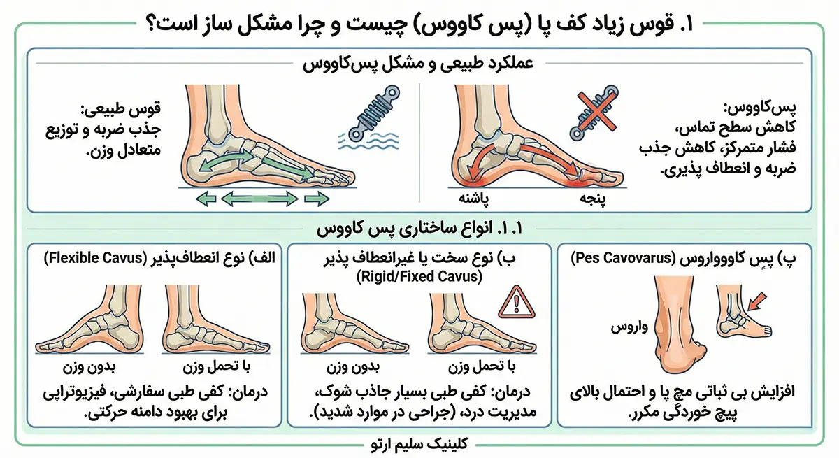 قوس زیاد کف پا قوس زیاد کف پا (پس کاووس) چیست و چرا مشکل ساز است؟